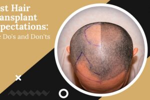 hair transplant expectations the do's and don'ts